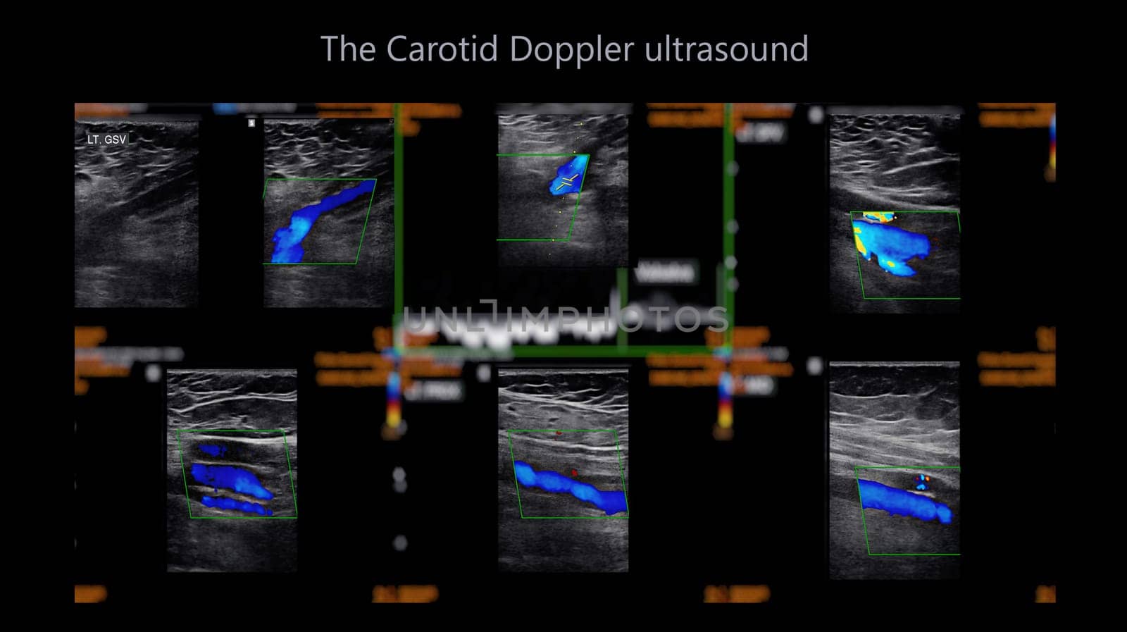 A carotid artery Doppler ultrasound is a diagnostic test used to check the arteries in the neck for diagnosis  any blockage in the veins by a blood clot or “thrombus” formation.