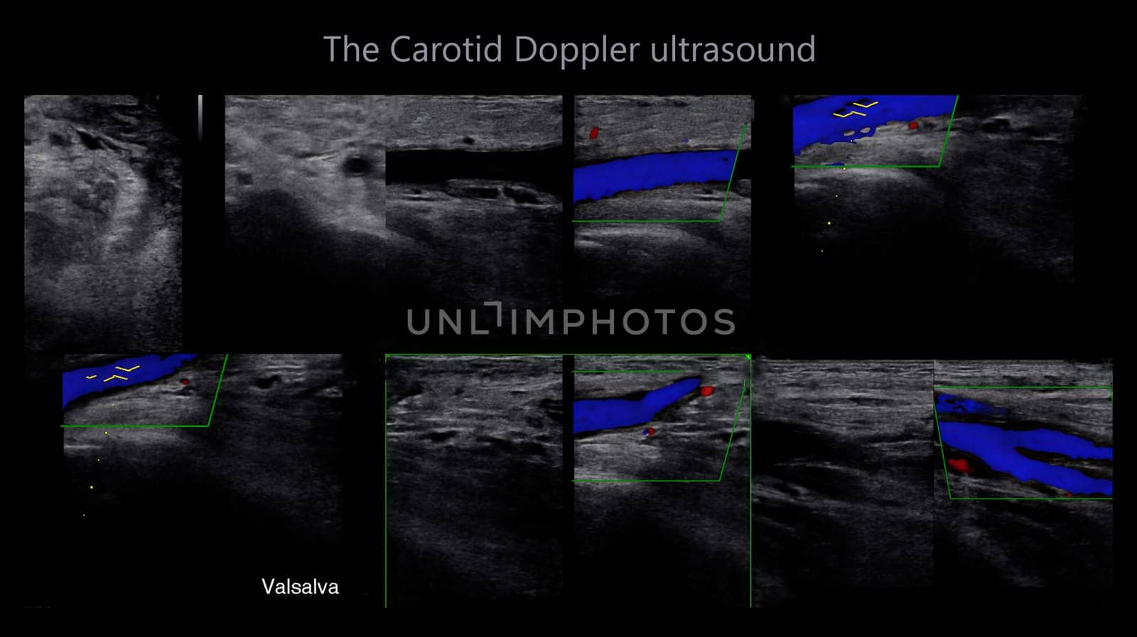 A carotid artery Doppler ultrasound is a diagnostic test used to check the arteries in the neck for diagnosis  any blockage in the veins by a blood clot or “thrombus” formation.