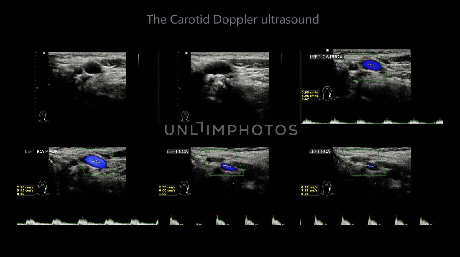 A carotid artery Doppler ultrasound is a diagnostic test used to check the arteries in the neck for diagnosis  any blockage in the veins by a blood clot or “thrombus” formation.