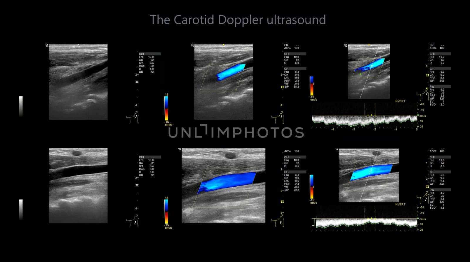 A carotid artery Doppler ultrasound is a diagnostic test used to check the arteries in the neck for diagnosis  any blockage in the veins by a blood clot or “thrombus” formation.