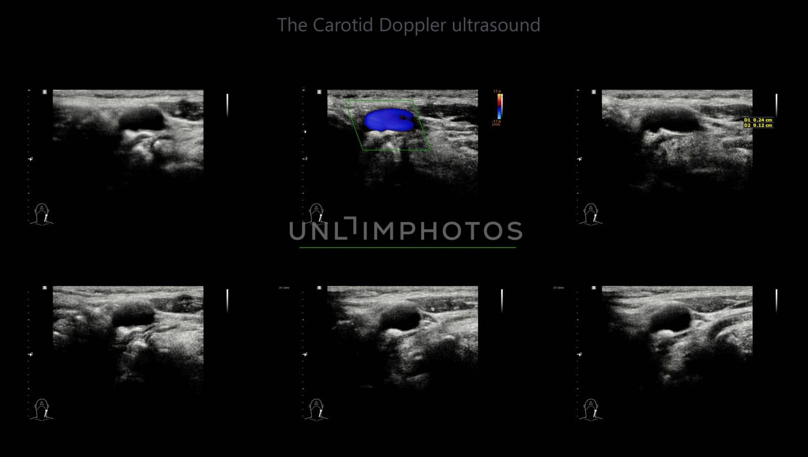 A carotid artery Doppler ultrasound is a diagnostic test used to check the arteries in the neck for diagnosis  any blockage in the veins by a blood clot or “thrombus” formation.