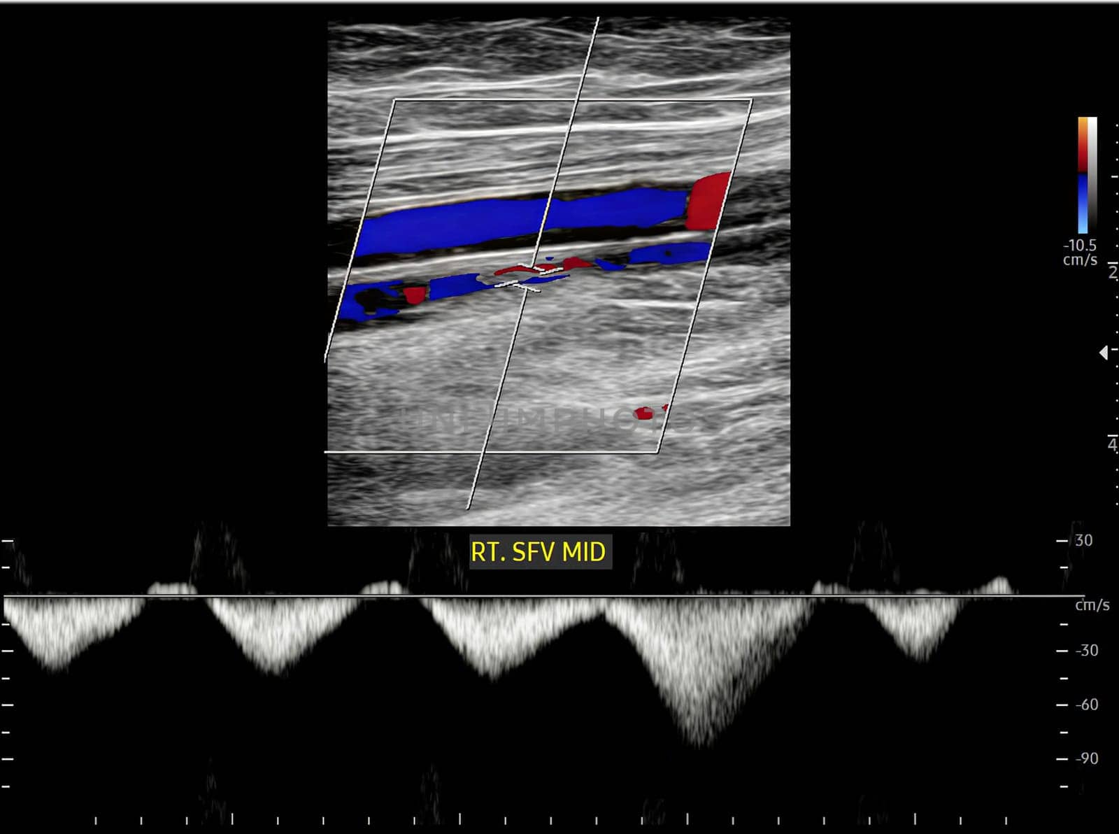 Color Doppler ultrasound determination in deep vein thrombosis patients for finding  deep vein thrombosis of lower extremity.