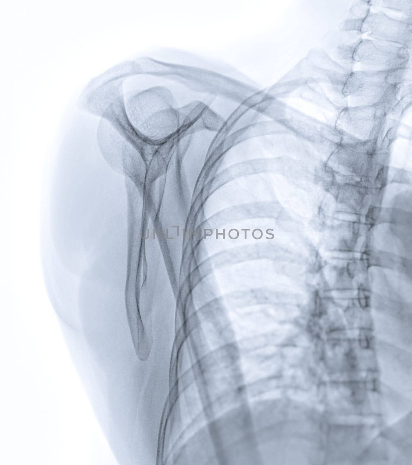 X-ray of Shoulder joint  transcapula view  showing normal scapula bone