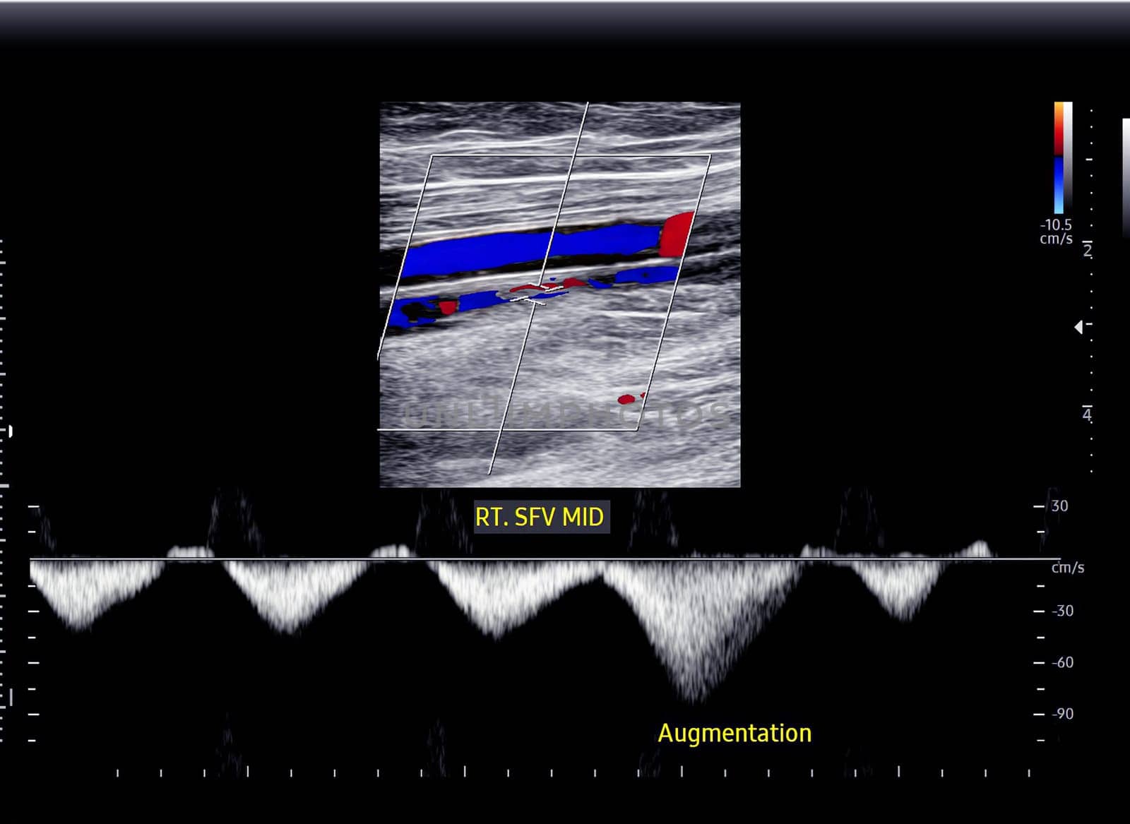 Color Doppler ultrasound determination in deep vein thrombosis patients for finding  deep vein thrombosis of lower extremity.