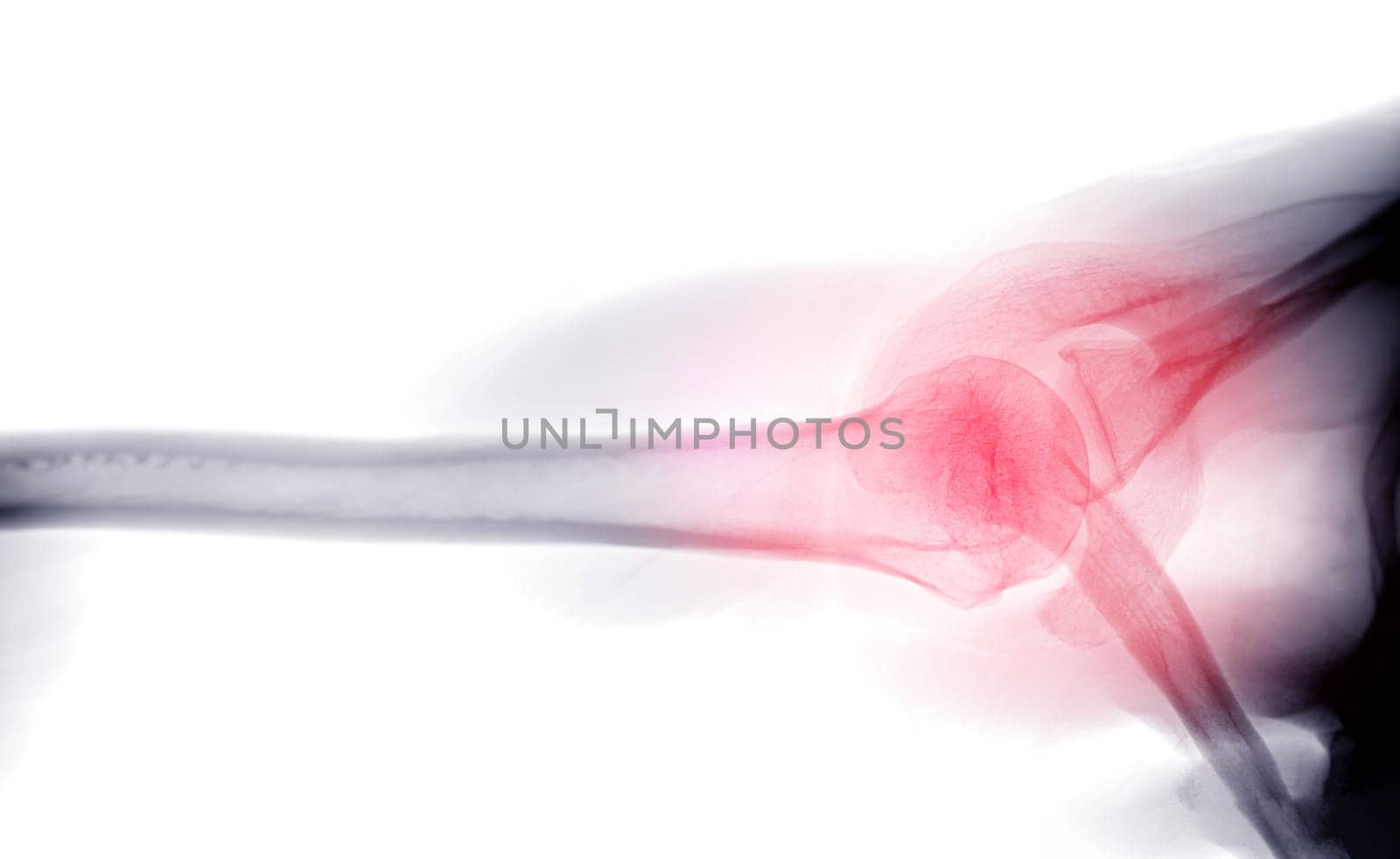 X-ray Shoulder joint shoulder transaxillary view for diagnosis fracture of shoulder joint.