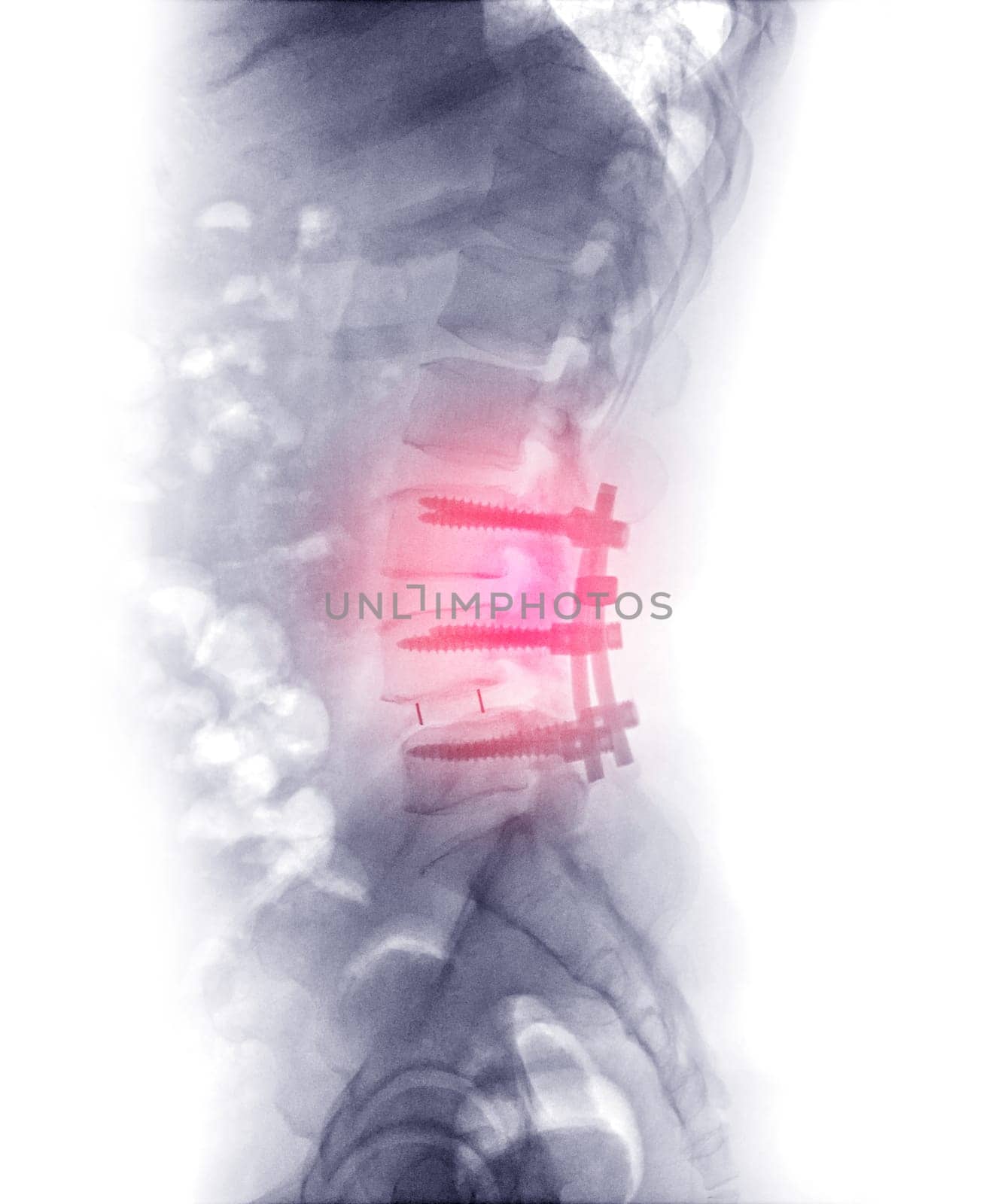 X-ray image of lumbar Spine  or L-s spine  Post operative  Fix Lumbar Plates and screw.