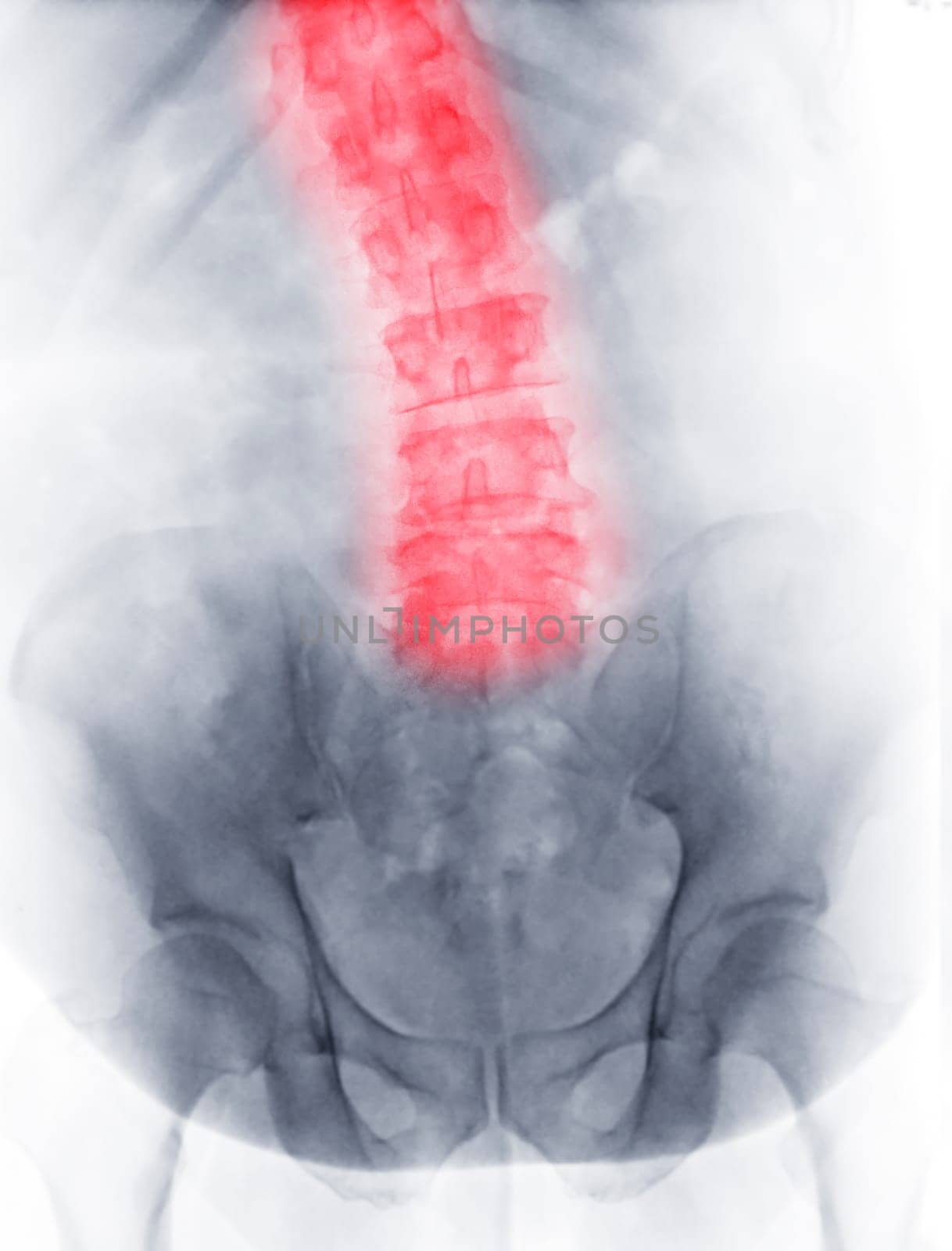 X-ray image of lumbar Spine  or L-s spine Front view showing scoliosis.