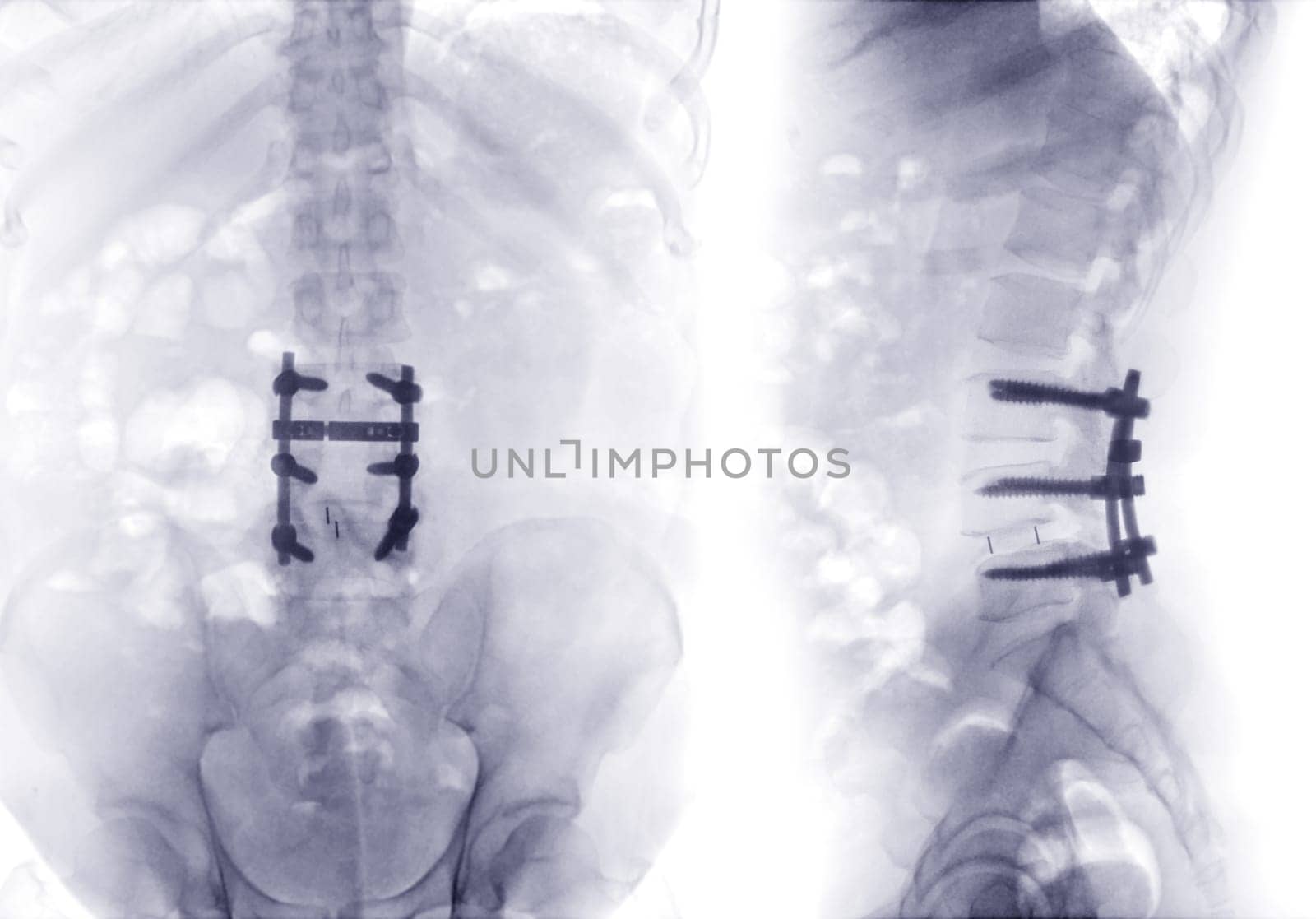 X-ray image of lumbar Spine  or L-s spine AP and lateral view Post operative  Fix Lumbar Plates and screw.