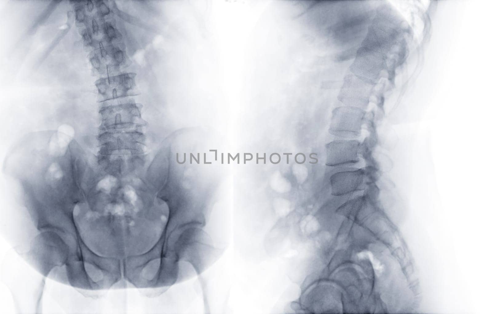 X-ray image of lumbar Spine  or L-s spine AP and lateral view for diagnosis lower back pain.