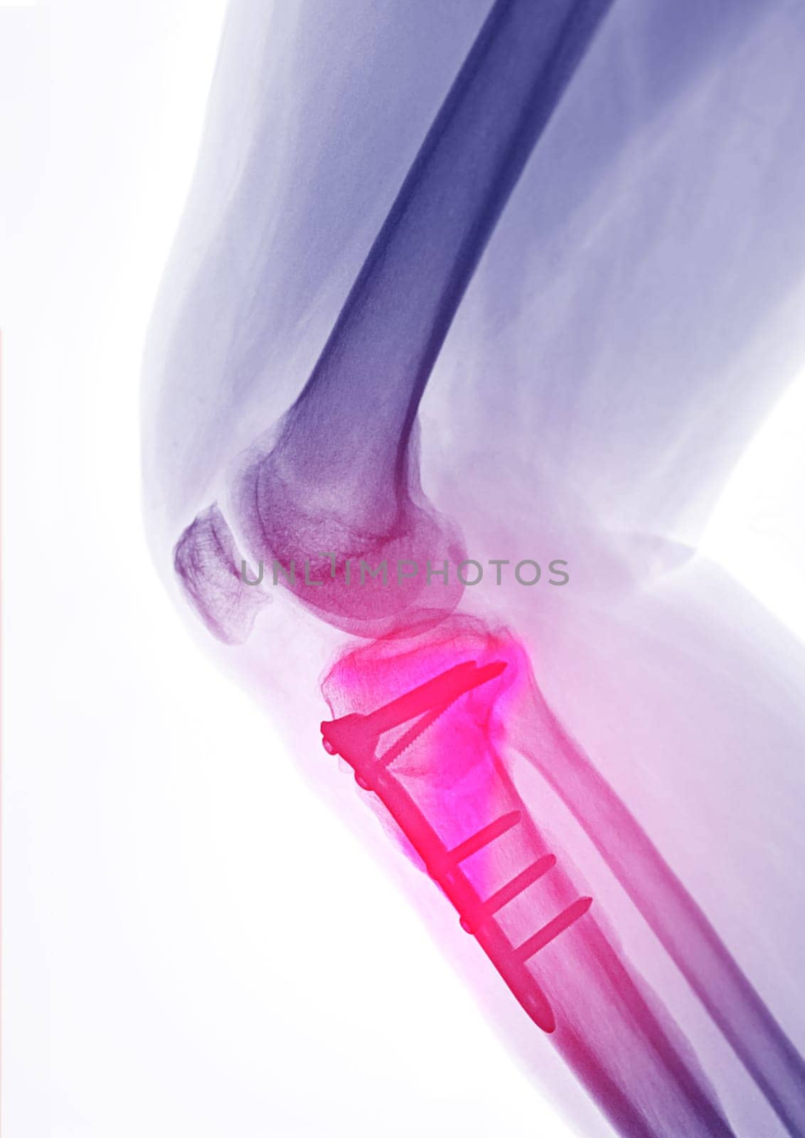 X-ray image of  Right knee  Lateral view showing Total knee arthroplasty and fractures of the tibial plateau with plate and screw fixation.