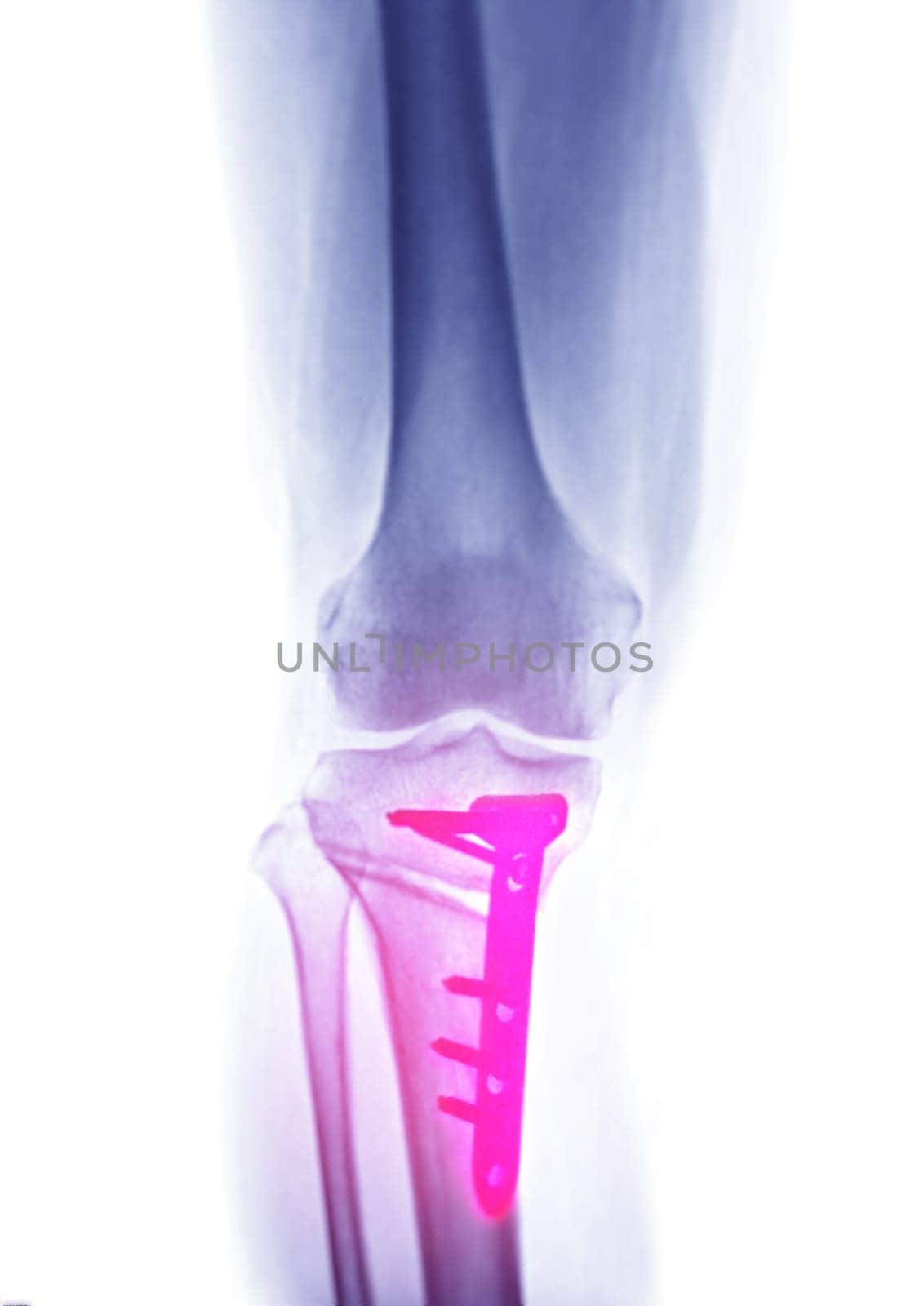 X-ray image of  Right knee  AP  view showing Total knee arthroplasty and fractures of the tibial plateau with plate and screw fixation.