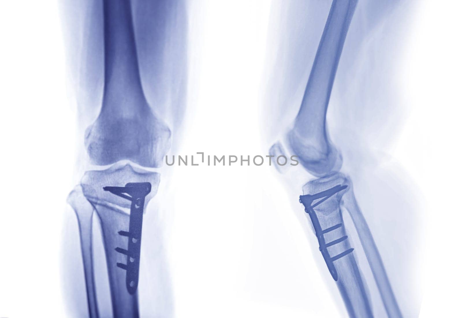 x-ray image of  Right knee  AP and Lateral view showing Total knee arthroplasty and fractures of the tibial plateau with plate and screw fixation.