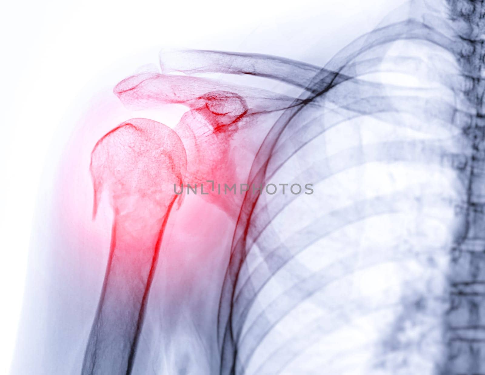 X-ray of Shoulder joint  showing fracture of humerus bone.