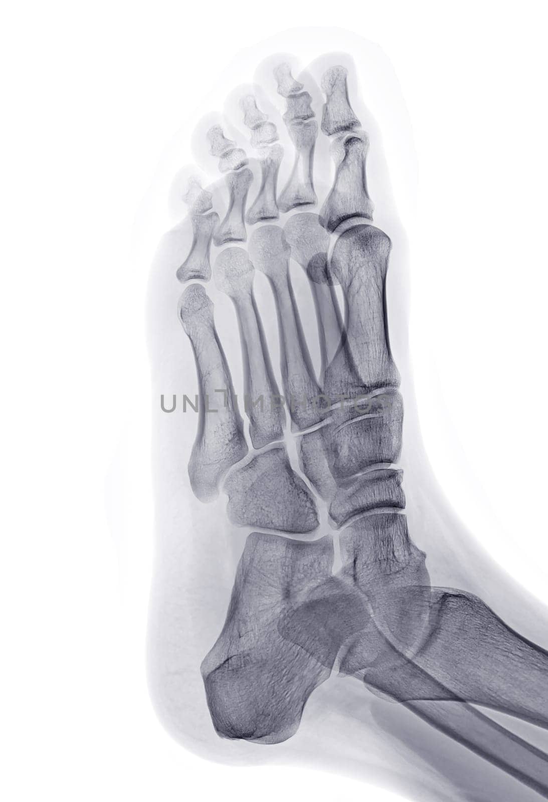 Foot x-ray image Oblique  view  isolated on White  background.
