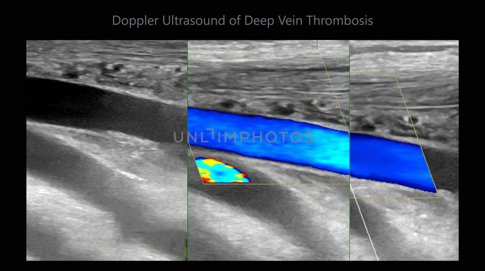 Color Doppler ultrasound determination in deep vein thrombosis patients for finding  deep vein thrombosis of lower extremity.