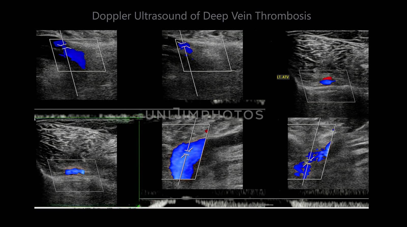 Color Doppler ultrasound determination in deep vein thrombosis patients for finding  deep vein thrombosis of lower extremity.