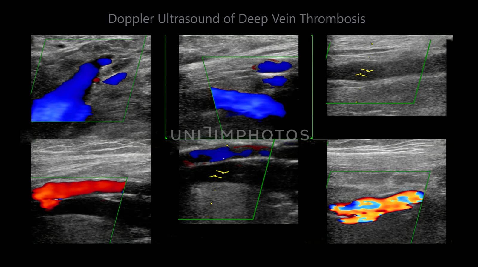 Color Doppler ultrasound determination in deep vein thrombosis patients for finding  deep vein thrombosis of lower extremity.