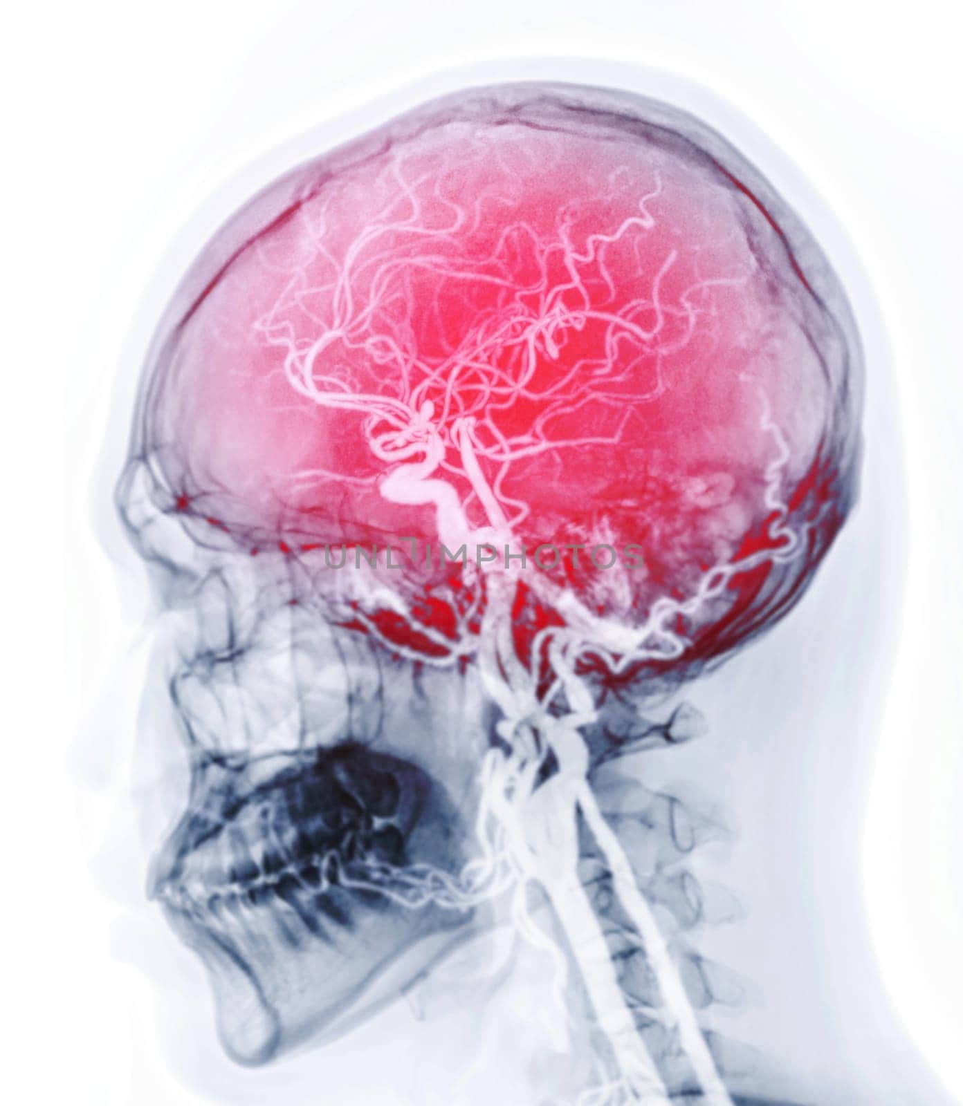  CTA brain or CT angiography of the brain 3D Rendering image fusion with skull lateral view  showing Cerebral artery and common carotid artery in the brain.