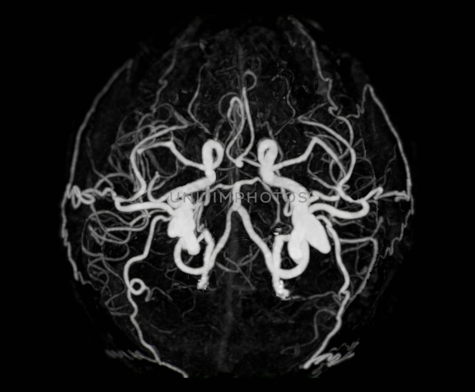 CT angiography of the brain or CTA brain showing Cerebral artery.