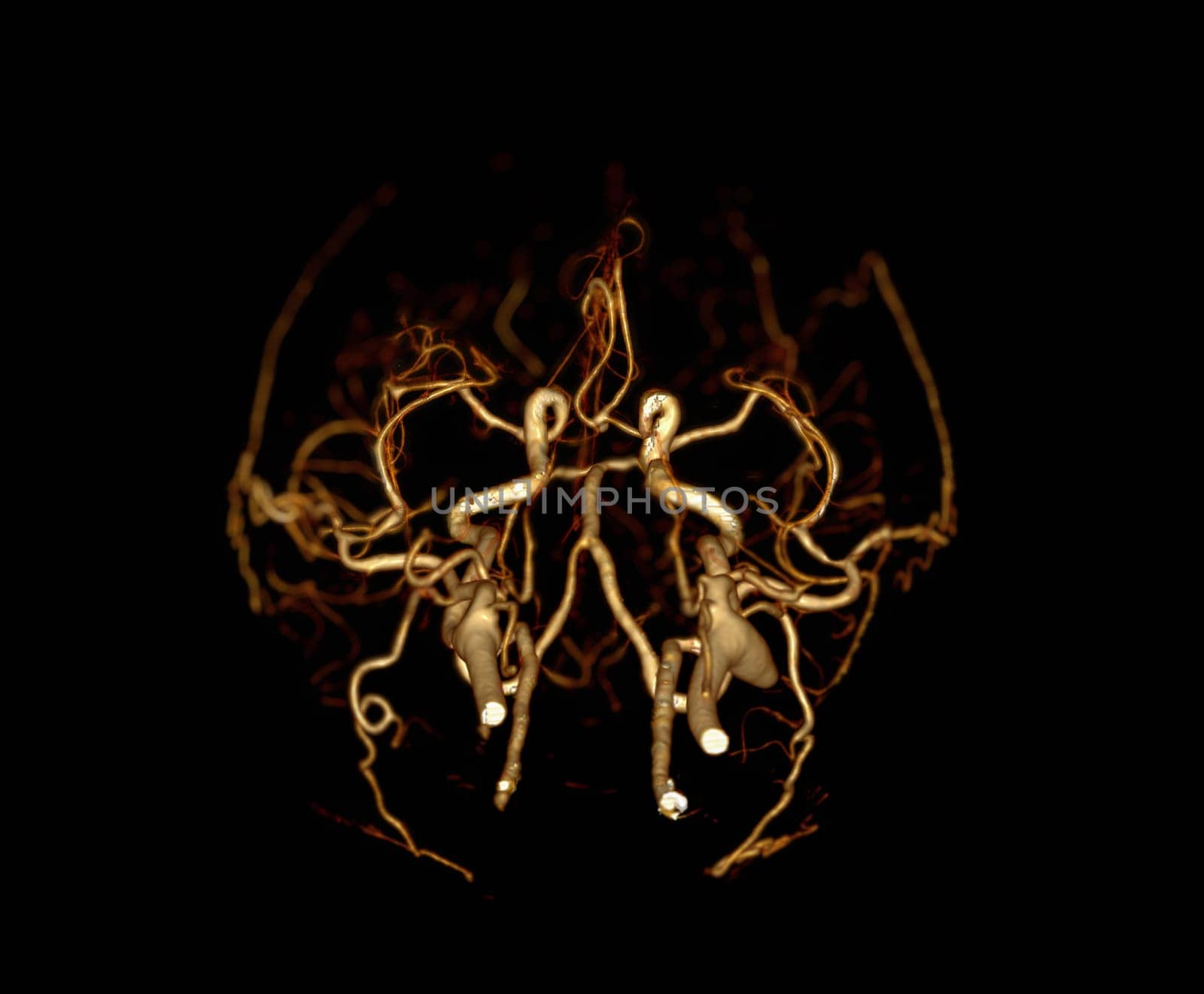 CT angiography of the brain or CTA brain showing Cerebral artery.