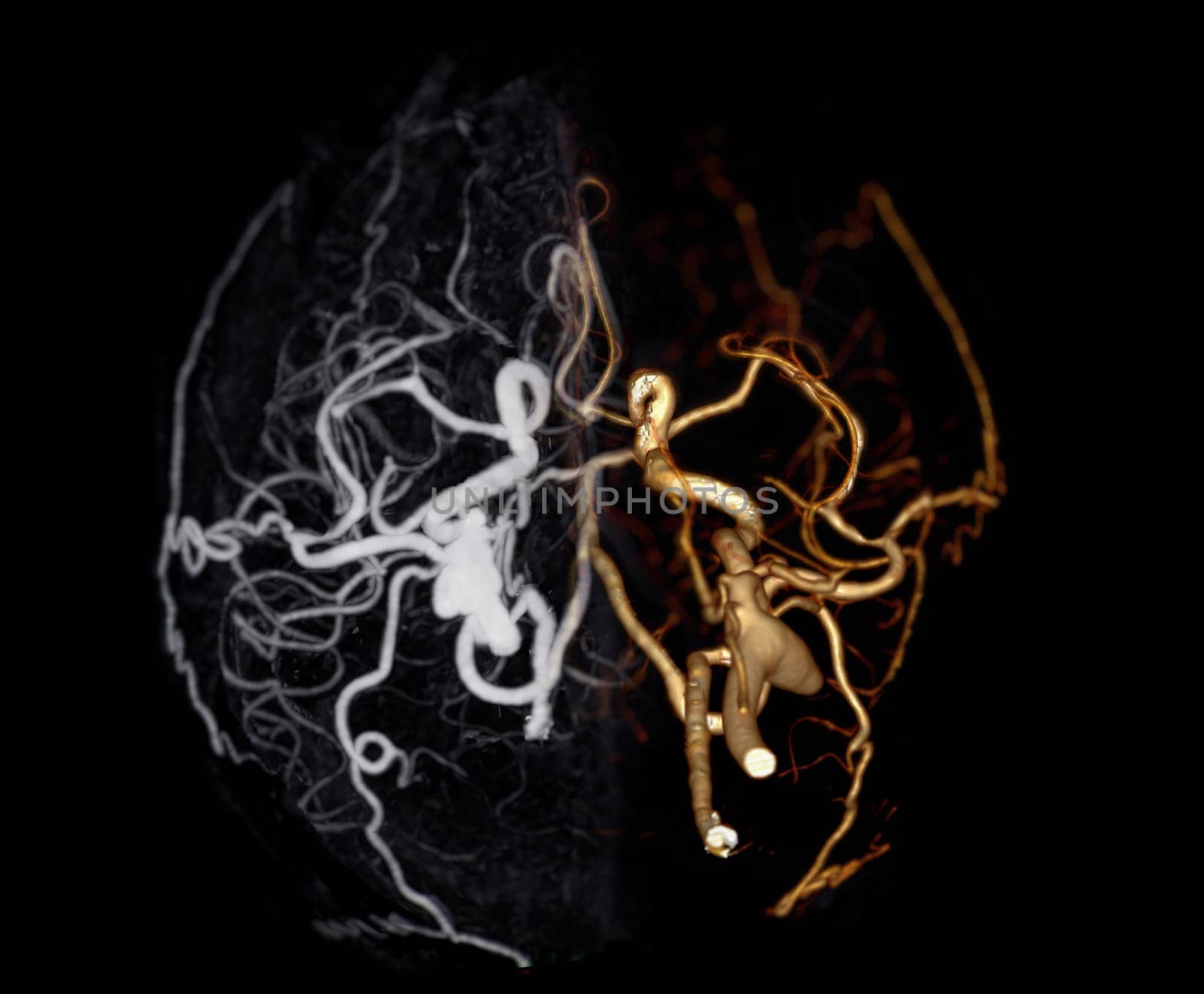 CT angiography of the brain or CTA brain showing Cerebral aryery. by samunella