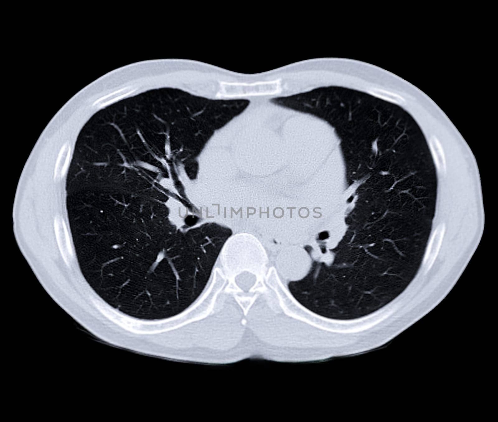 CT scan of Chest or lung for screening lung nodules and lung cancer . by samunella