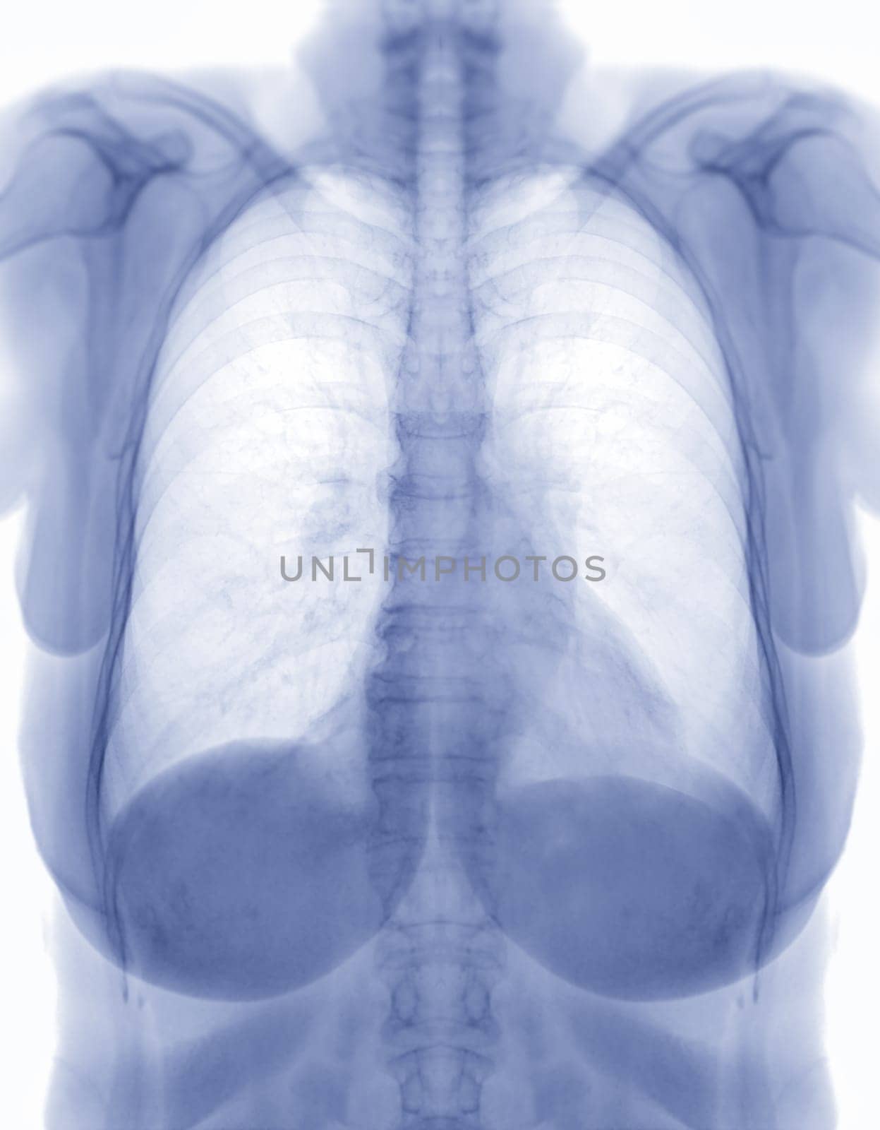 Chest x-ray image Negative filter.