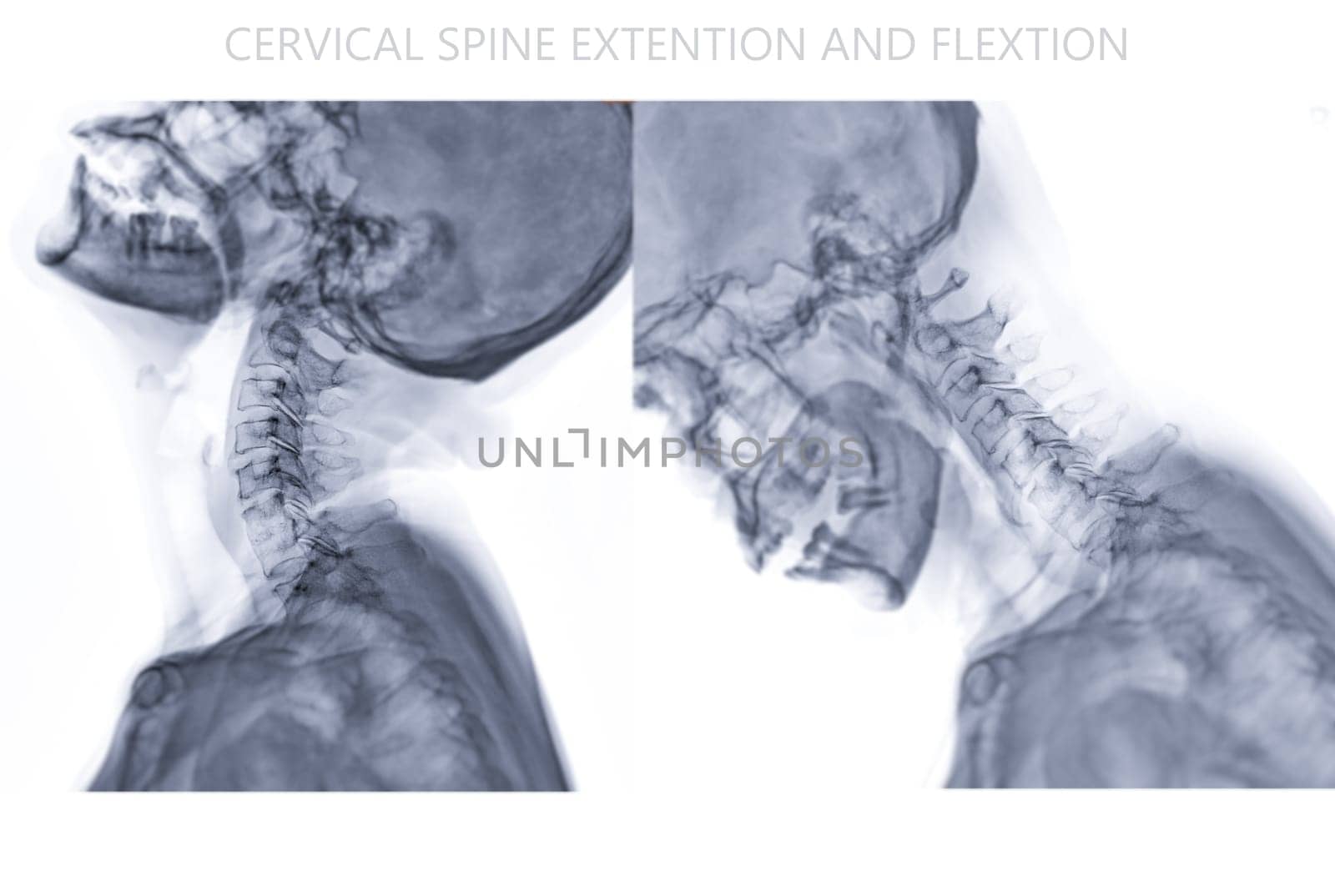 X-ray C-spine or x-ray image of Cervical spine  Flexion and Extension viewfor diagnostic intervertebral disc herniation ,Spondylosis and fracture. by samunella