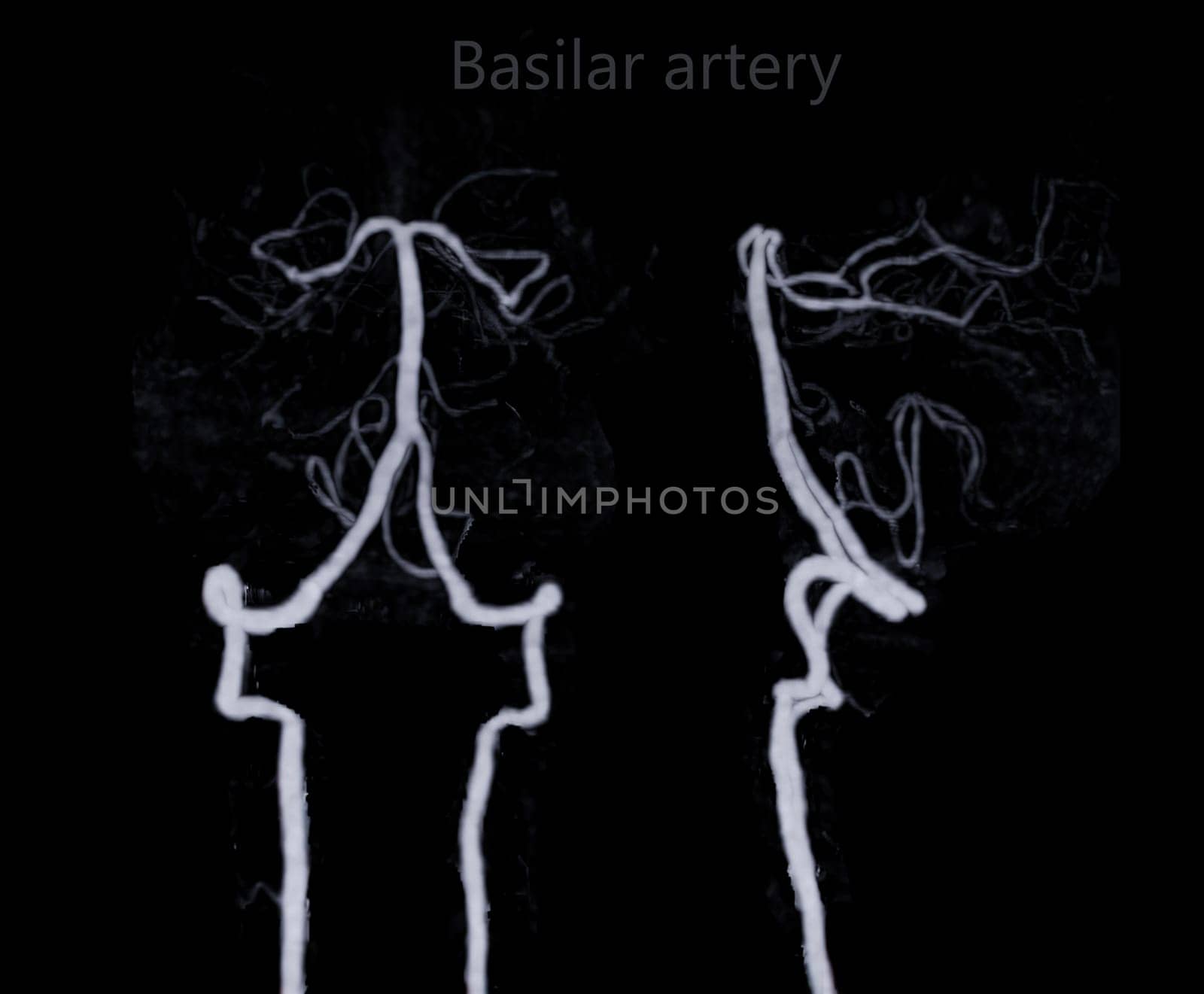 CT angiography of the brain or CTA brain showing basilar artery.