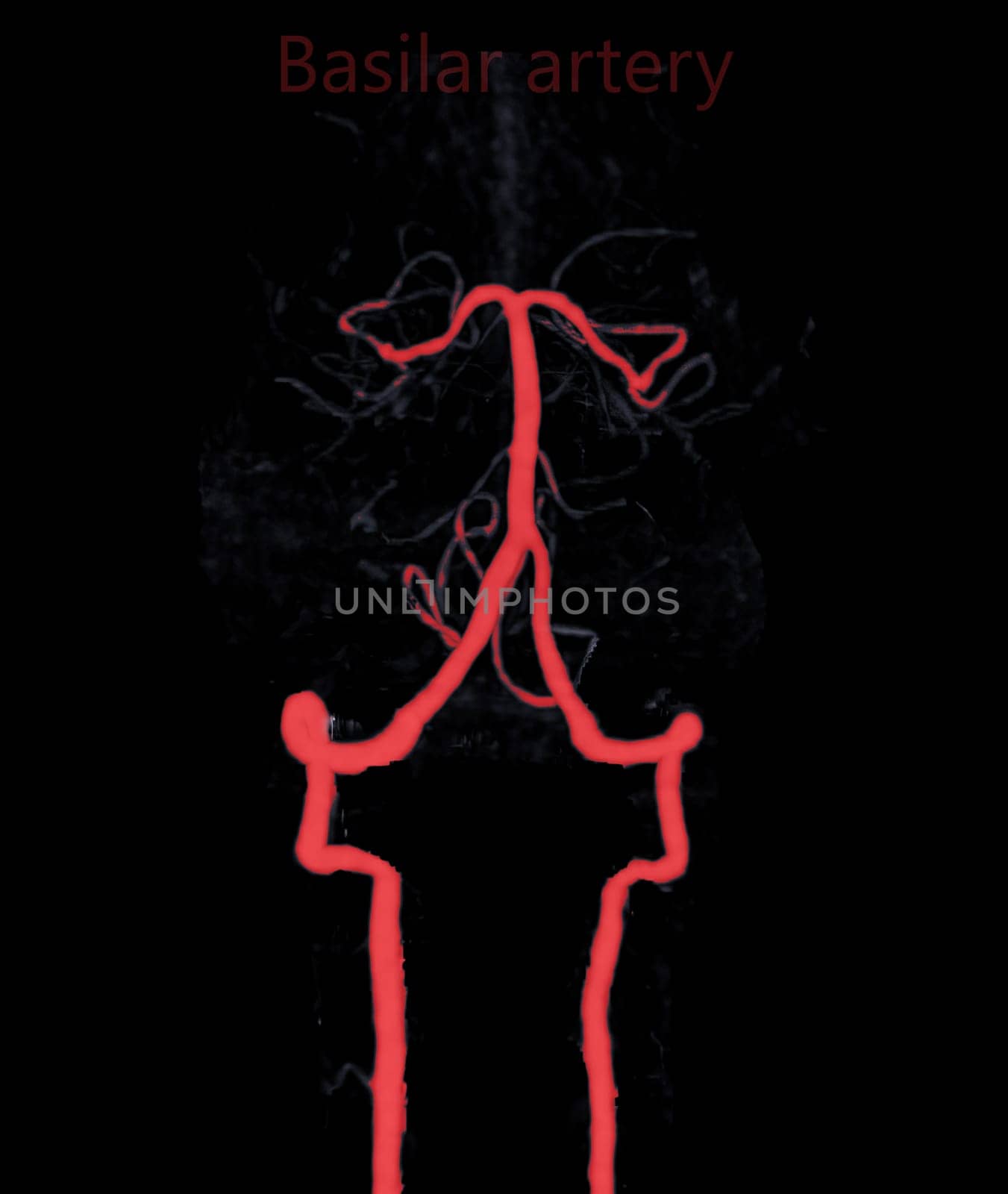 CT angiography of the brain or CTA brain showing basilar artery.