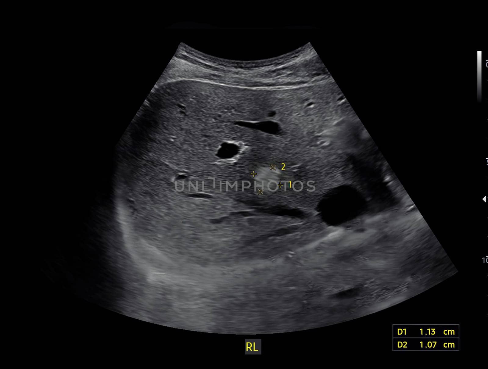 Ultrasound upper abdomen for diagnosis abdominal pain.