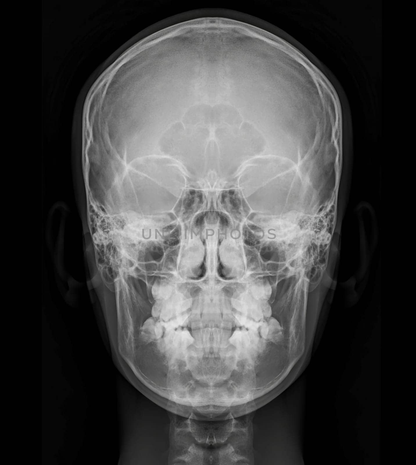 X-ray image of Human Skull   Front  view for diagnosis skull fracture  isolated on Black Background.