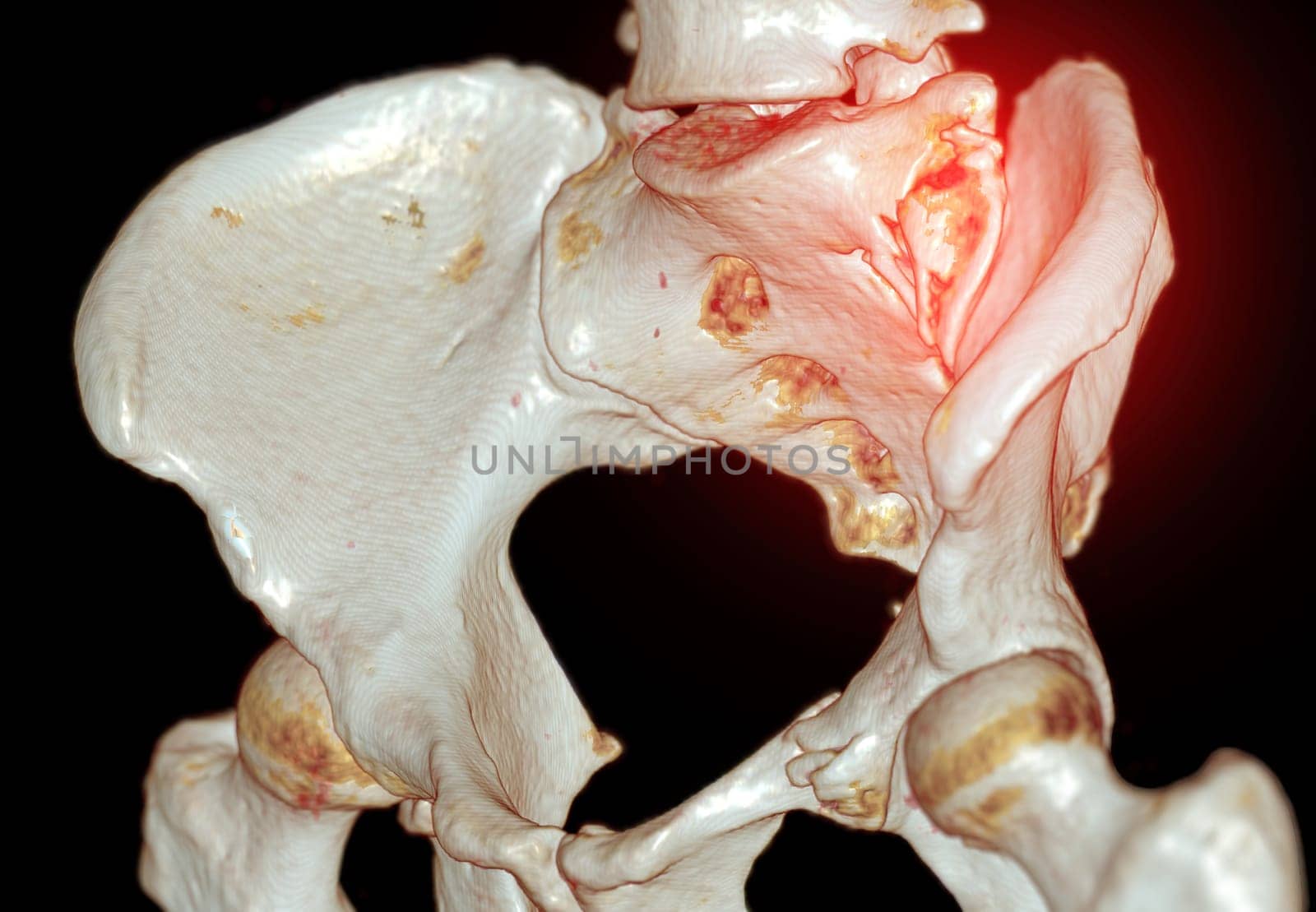 CT Scan pelvic bone with both hip joint 3D rendering  showign fracture of sacrum and superior pubic rumus.