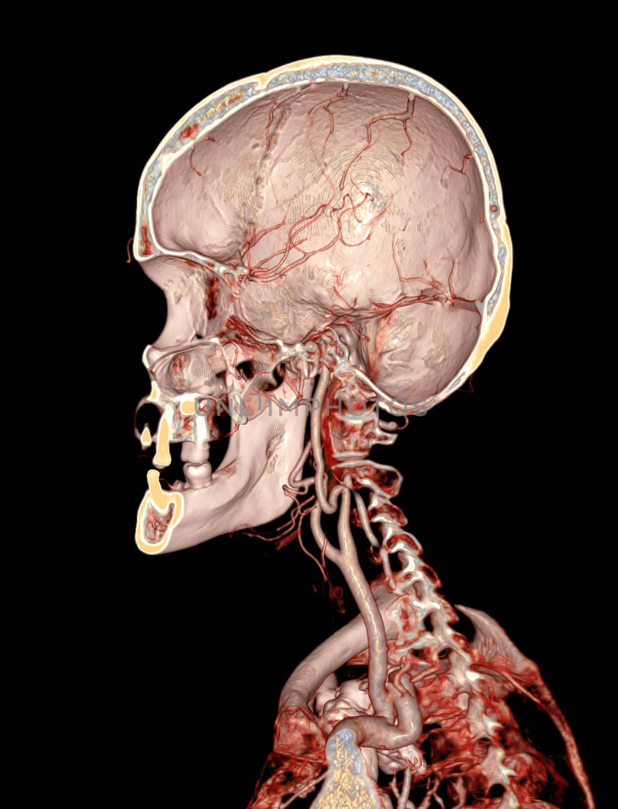  CTA brain and carotid artery or CT angiography of the brain  3D Rendering image .
