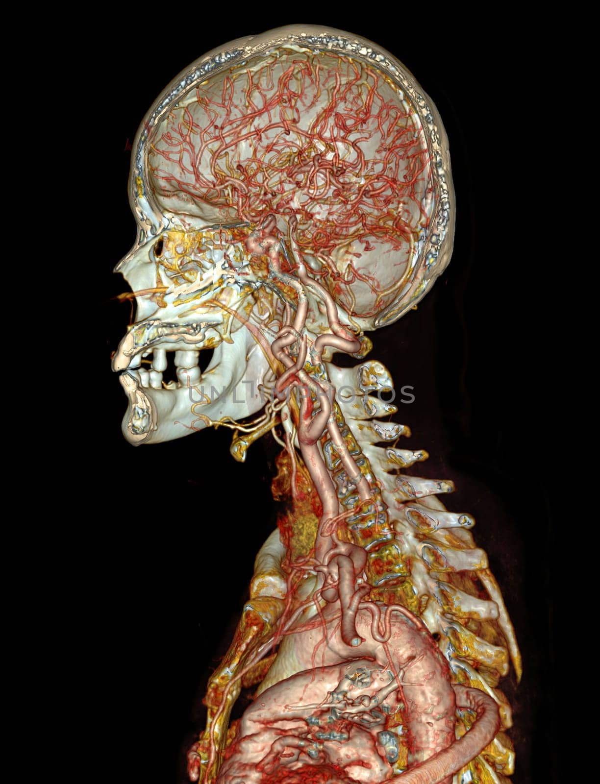  CTA brain and carotid artery or CT angiography of the brain  3D Rendering image .