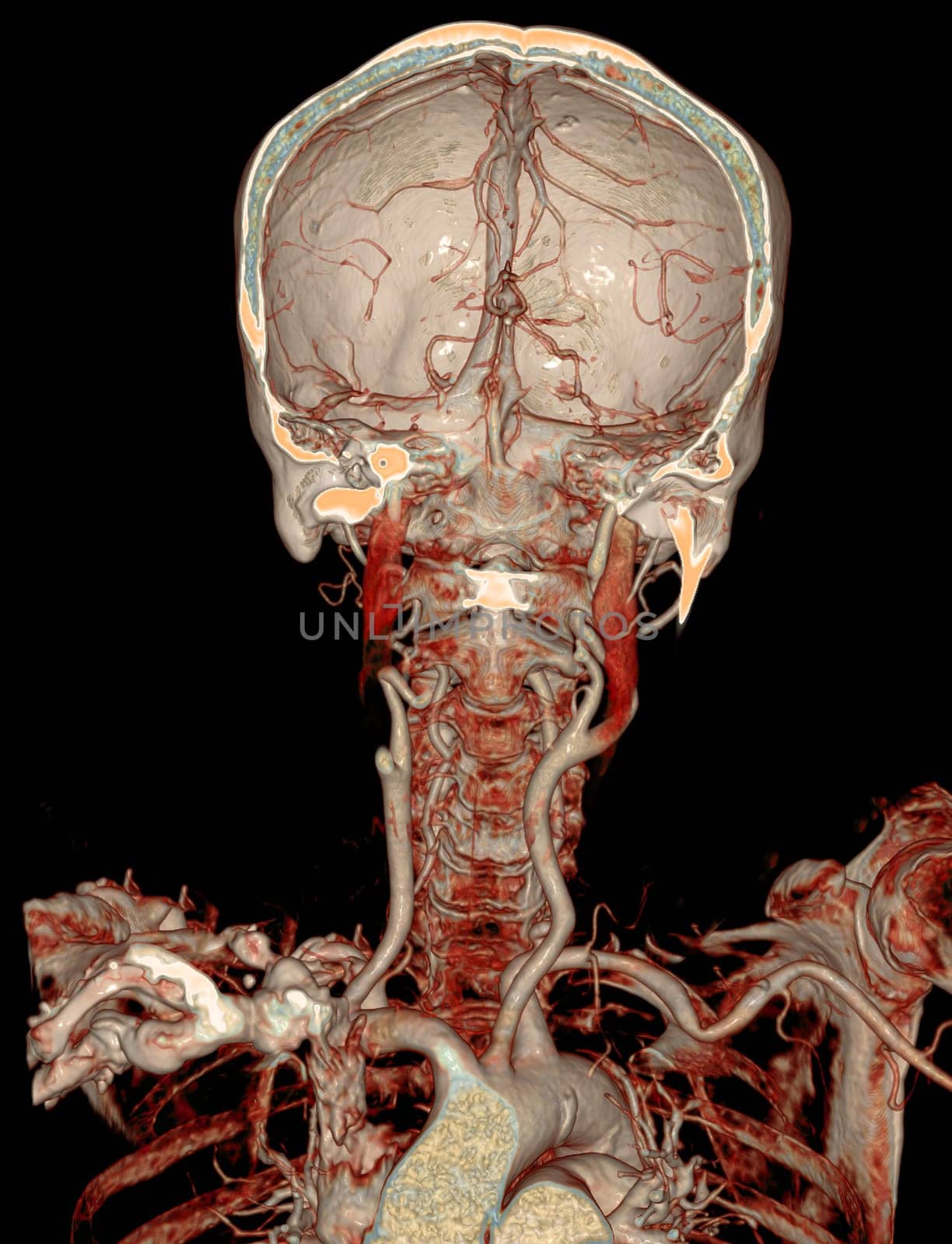  CTA brain and carotid artery or CT angiography of the brain  3D Rendering image . by samunella