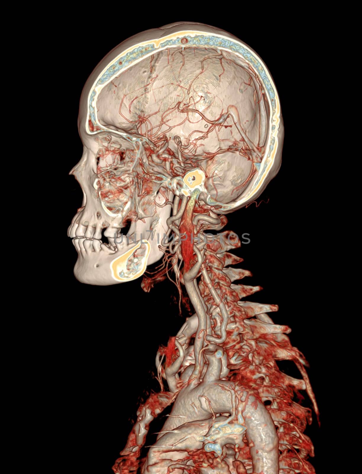  CTA brain and carotid artery or CT angiography of the brain  3D Rendering image . by samunella