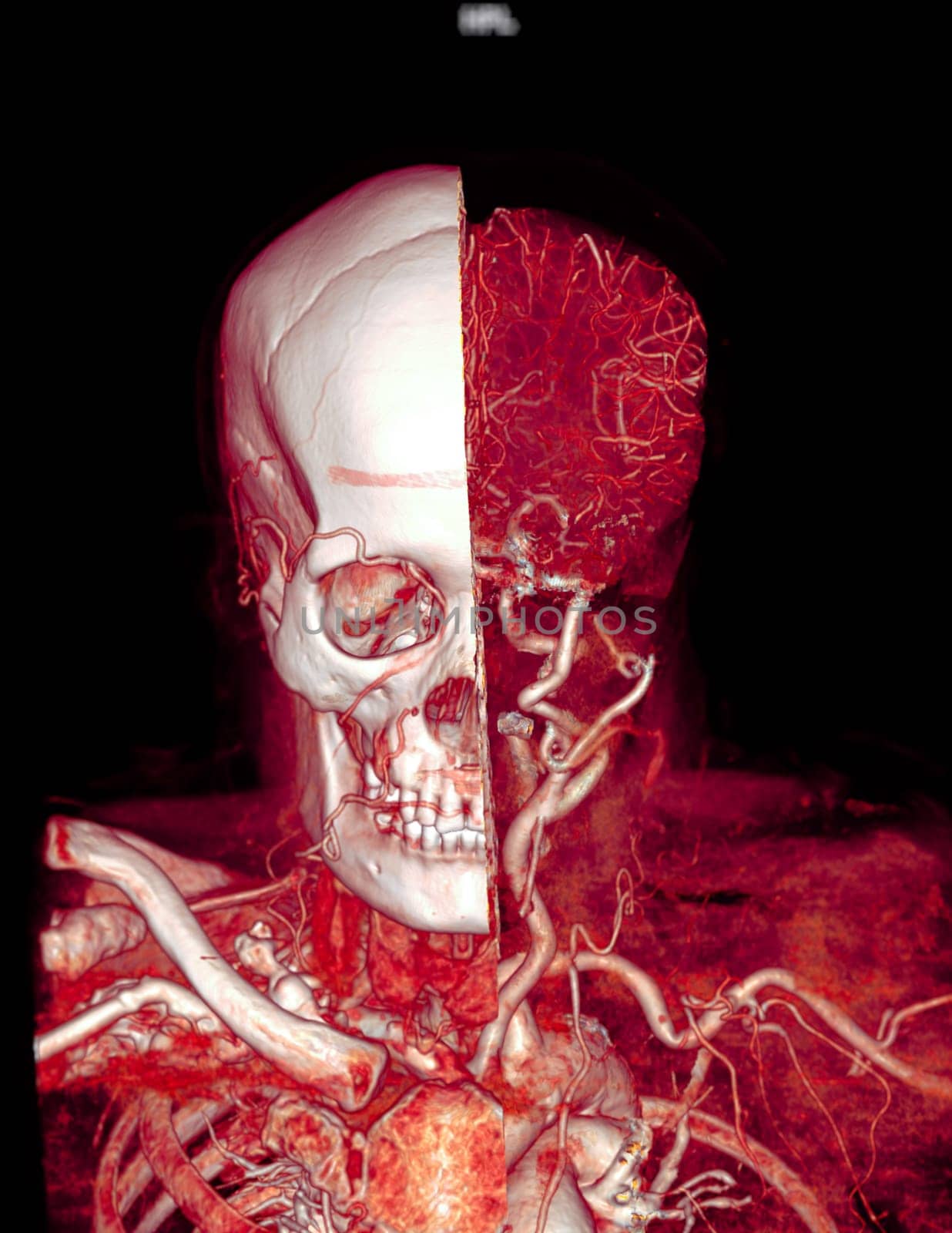  CTA brain and carotid artery or CT angiography of the brain  3D Rendering image . by samunella