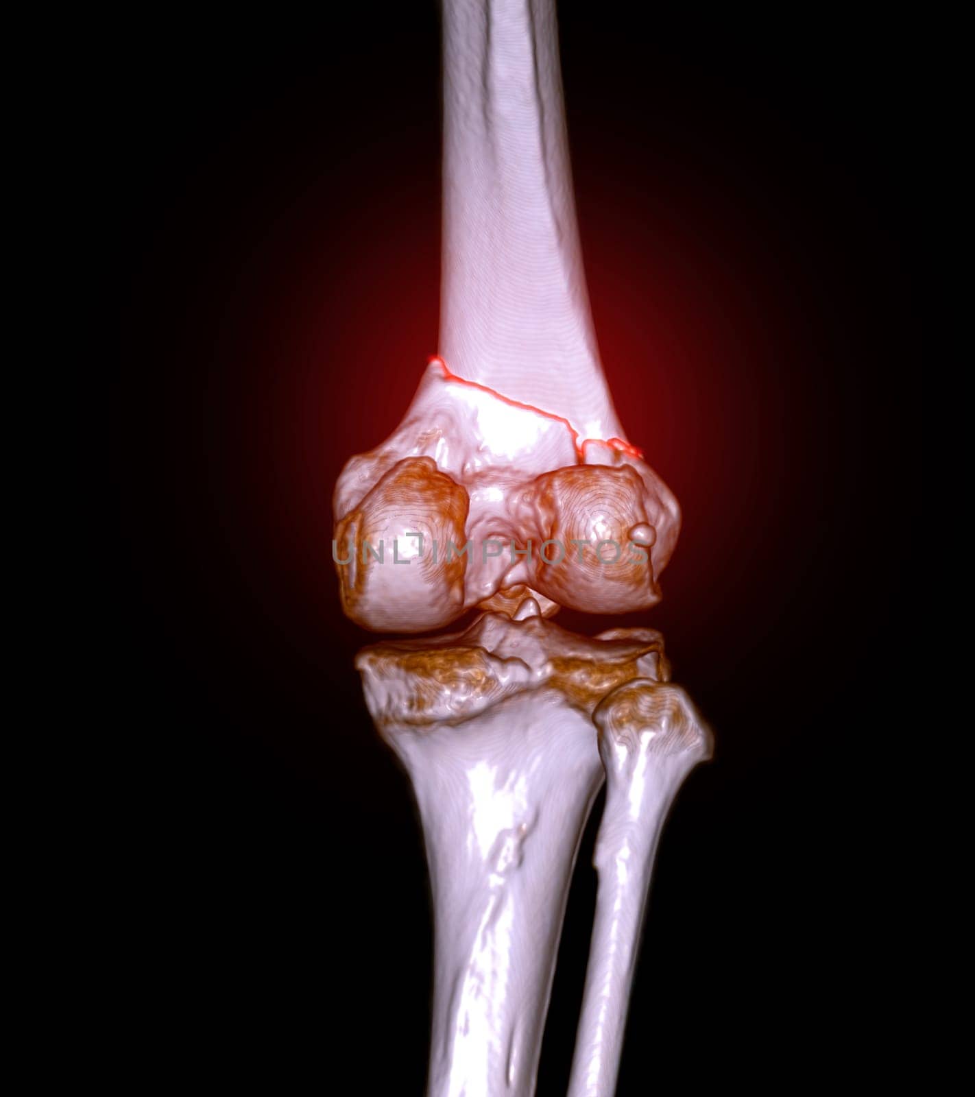 CT scan of knee joint 3D rendering image  showing fracture of distal femur bone. by samunella