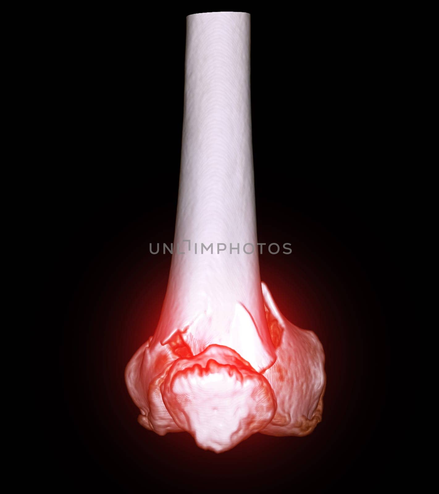 CT scan of knee joint 3D rendering image  showing fracture of distal femur bone. by samunella