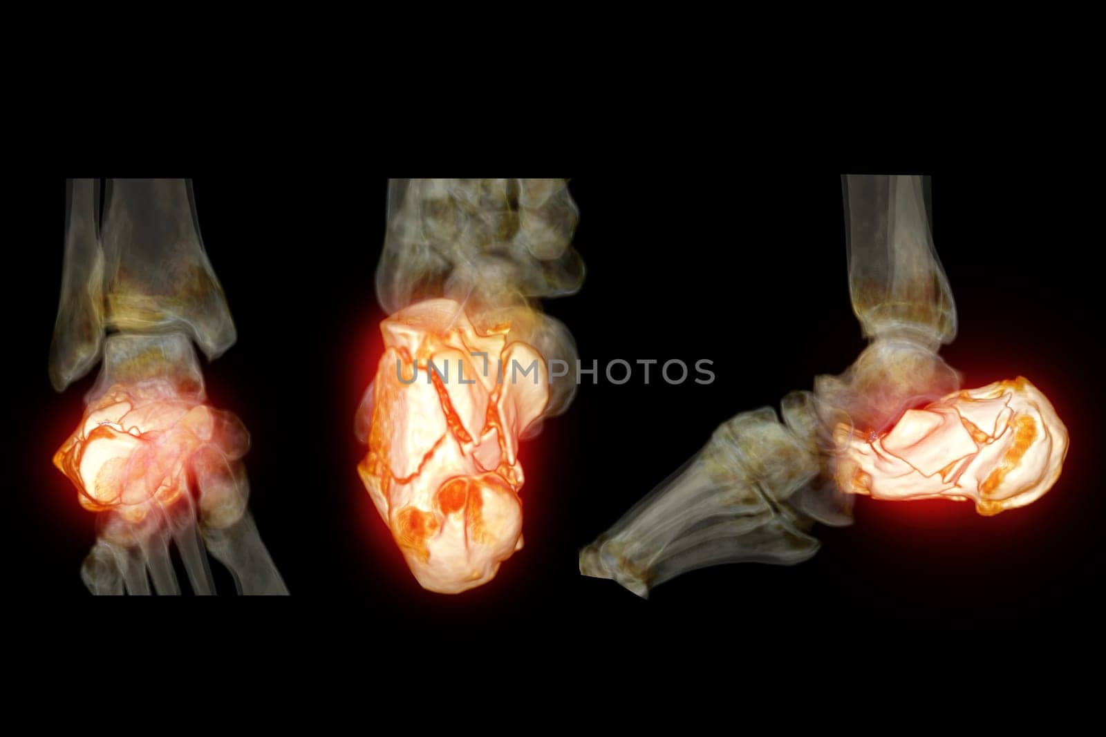 CT Scan ankle joint with  3d rendering of calcaneus bone showing Calcaneus (Heel Bone) Fractures.