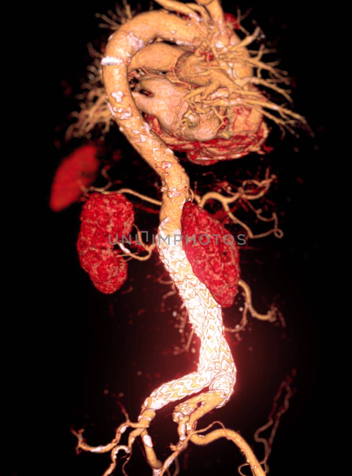 CTA whole aorta with Abdominal aorta stent graft 3D rendering image in case  abdominal aortic aneurysms. by samunella