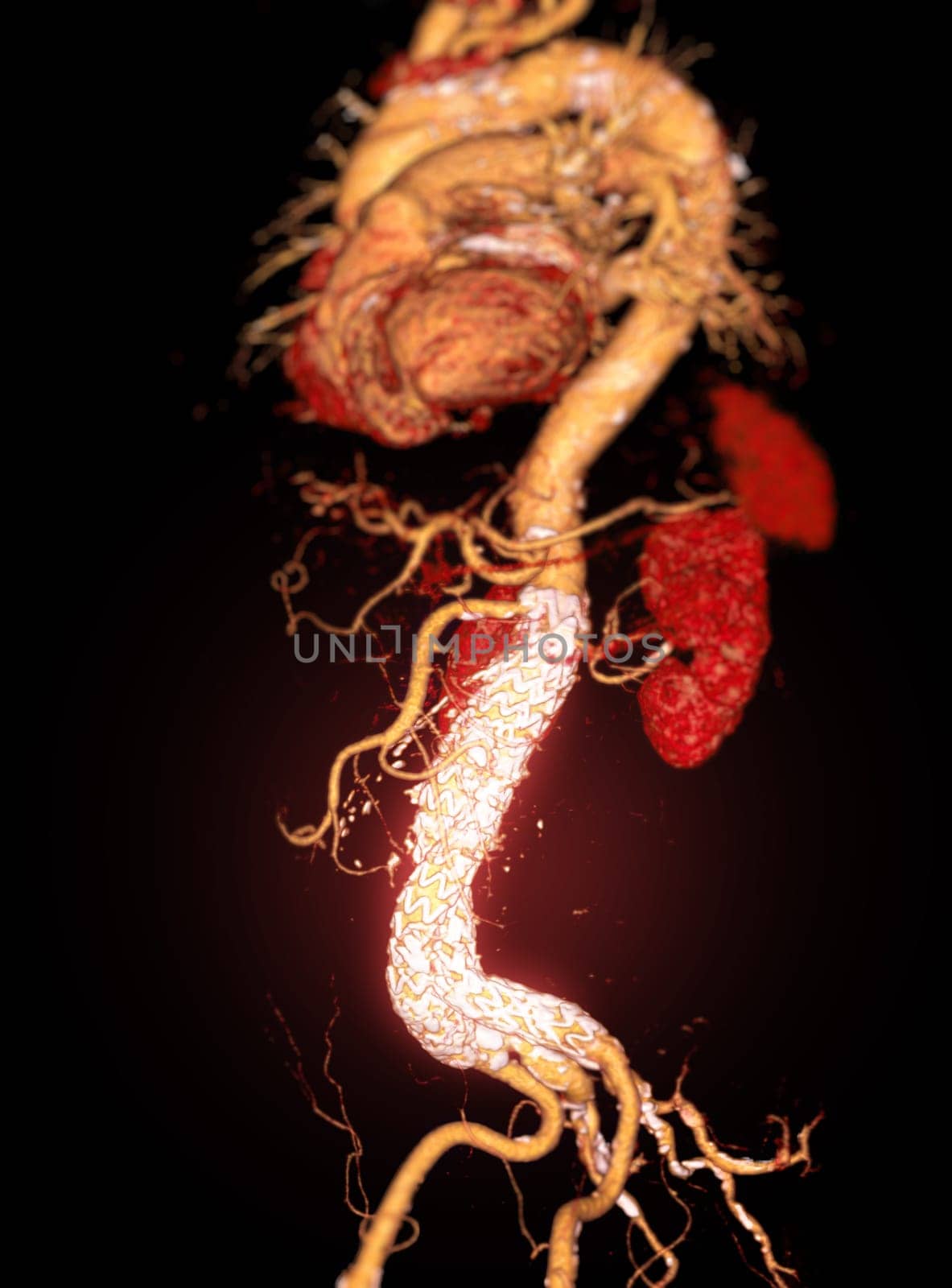 CTA whole aorta with Abdominal aorta stent graft 3D rendering image in case  abdominal aortic aneurysms.