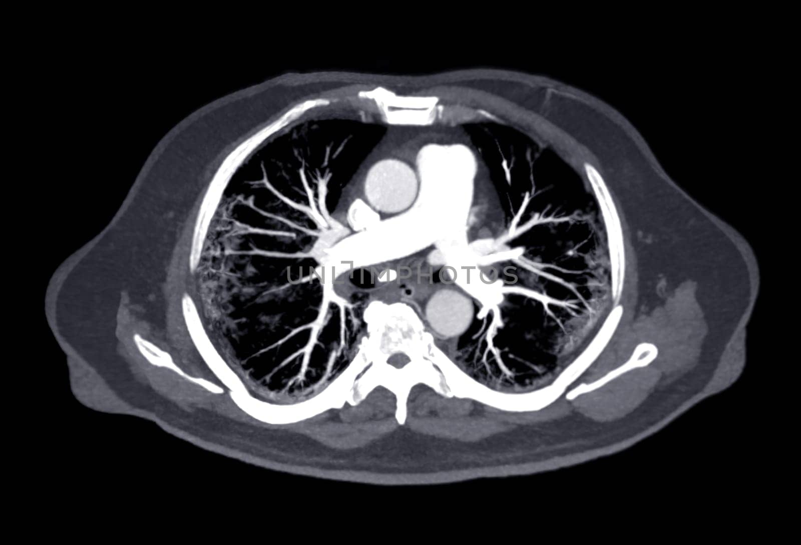 CTA pulmonary arteries 3D rendering showing branch of pulmonary artery by samunella