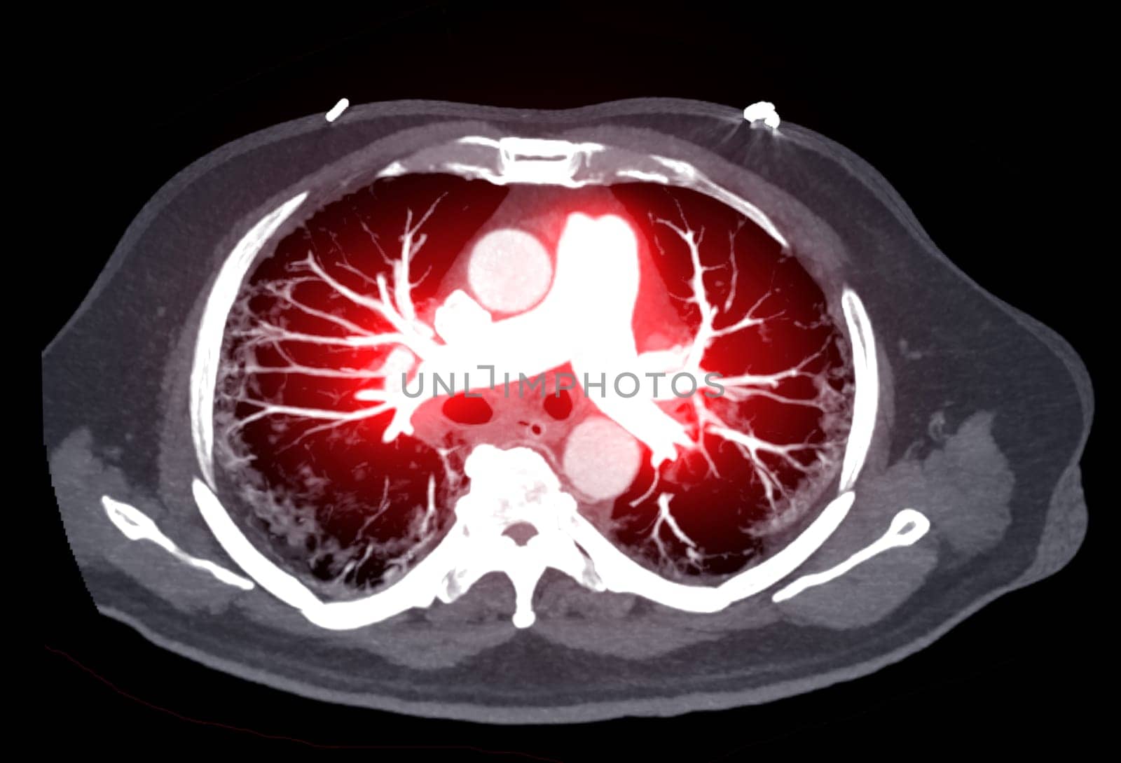 CTA pulmonary arteries 3D rendering showing branch of pulmonary artery by samunella