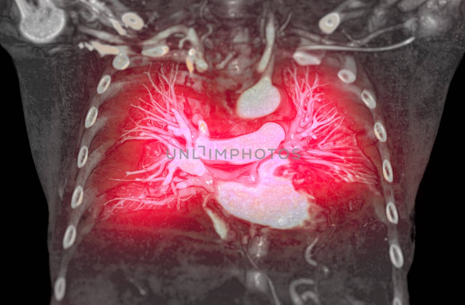 CTA pulmonary arteries 3D rendering showing branch of pulmonary artery by samunella