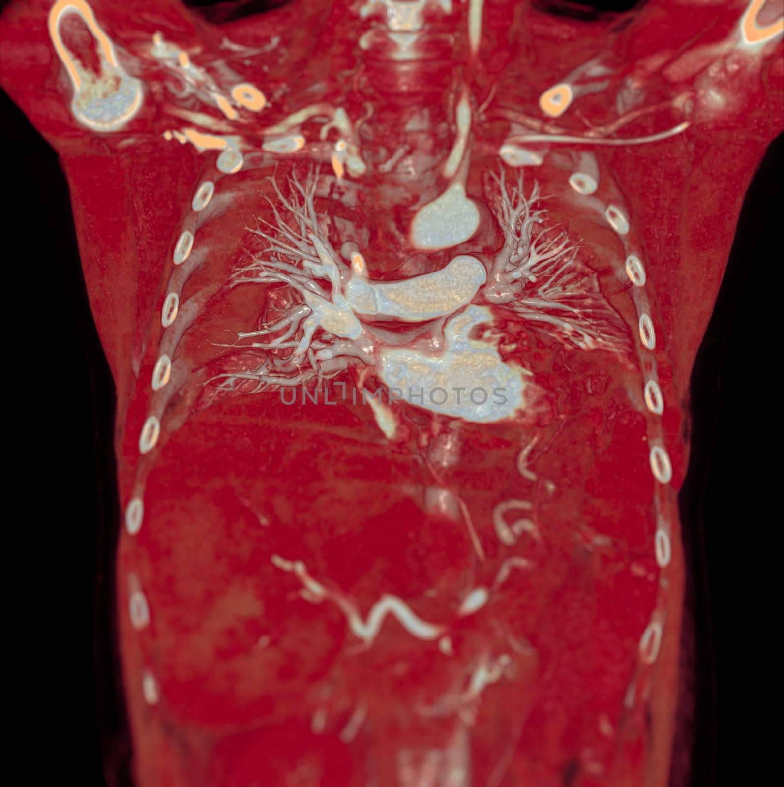 CTA pulmonary arteries 3D rendering showing branch of pulmonary artery