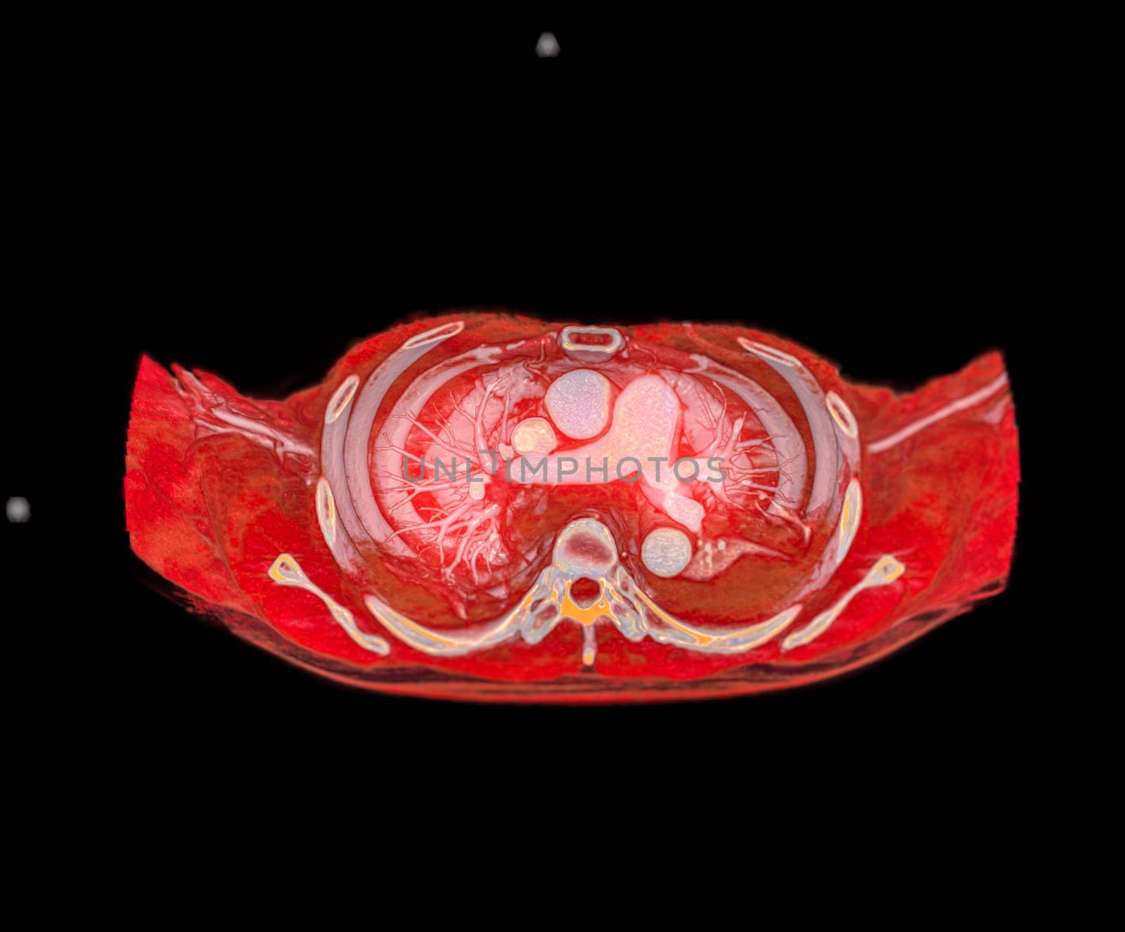 CTA pulmonary arteries 3D rendering showing branch of pulmonary artery by samunella