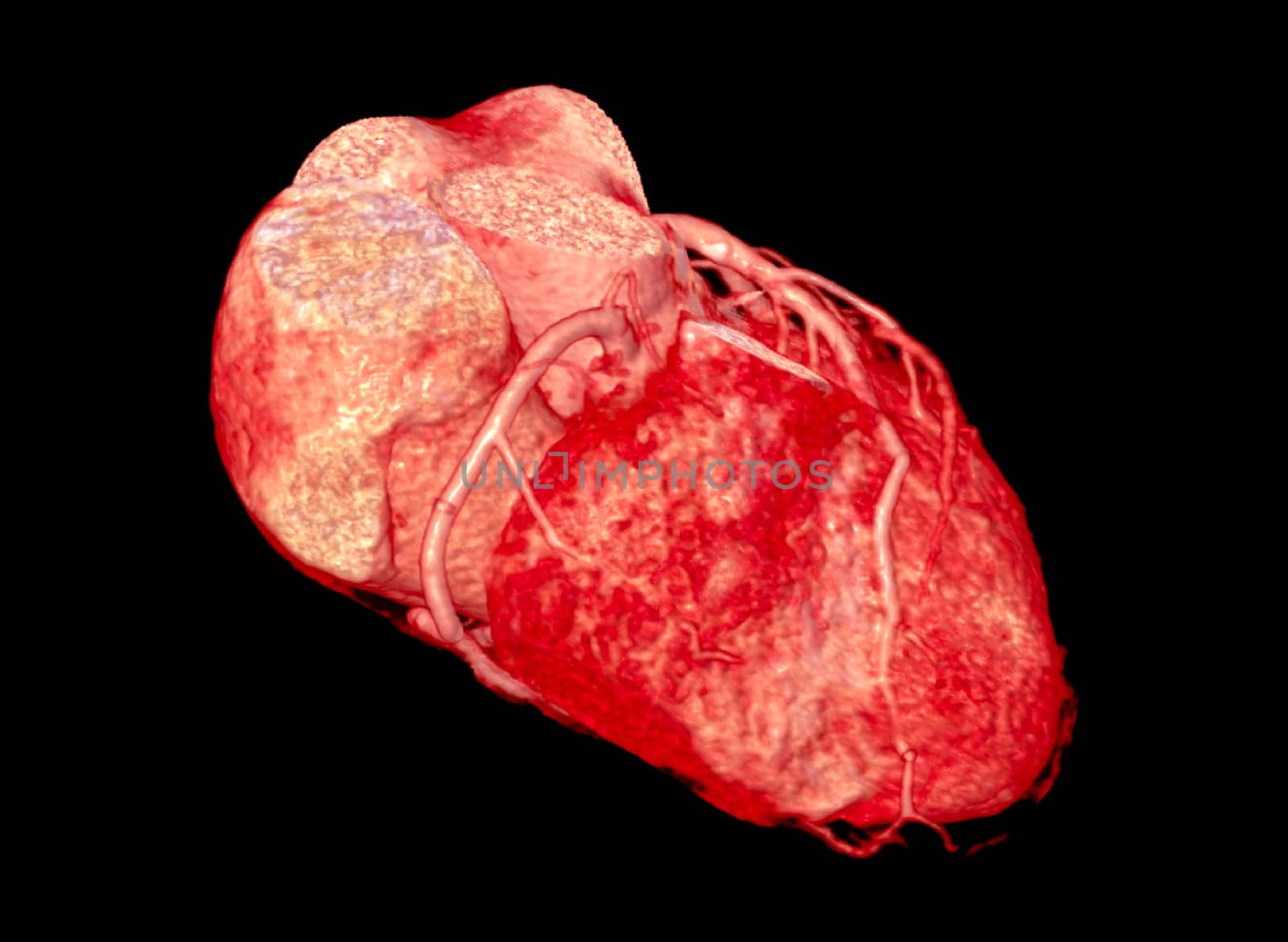 CTA Coronary artery  3D rendering image. by samunella