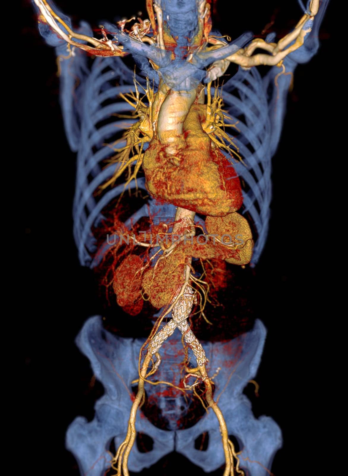 CTA of the aorta with stent-grafting in patient Abdominal aortic aneurysm. by samunella